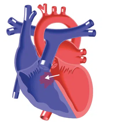 Ventricular Septal Defect_edited.png