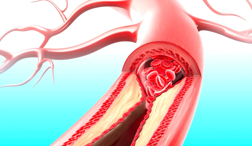 periferik arter hastaligi nedir